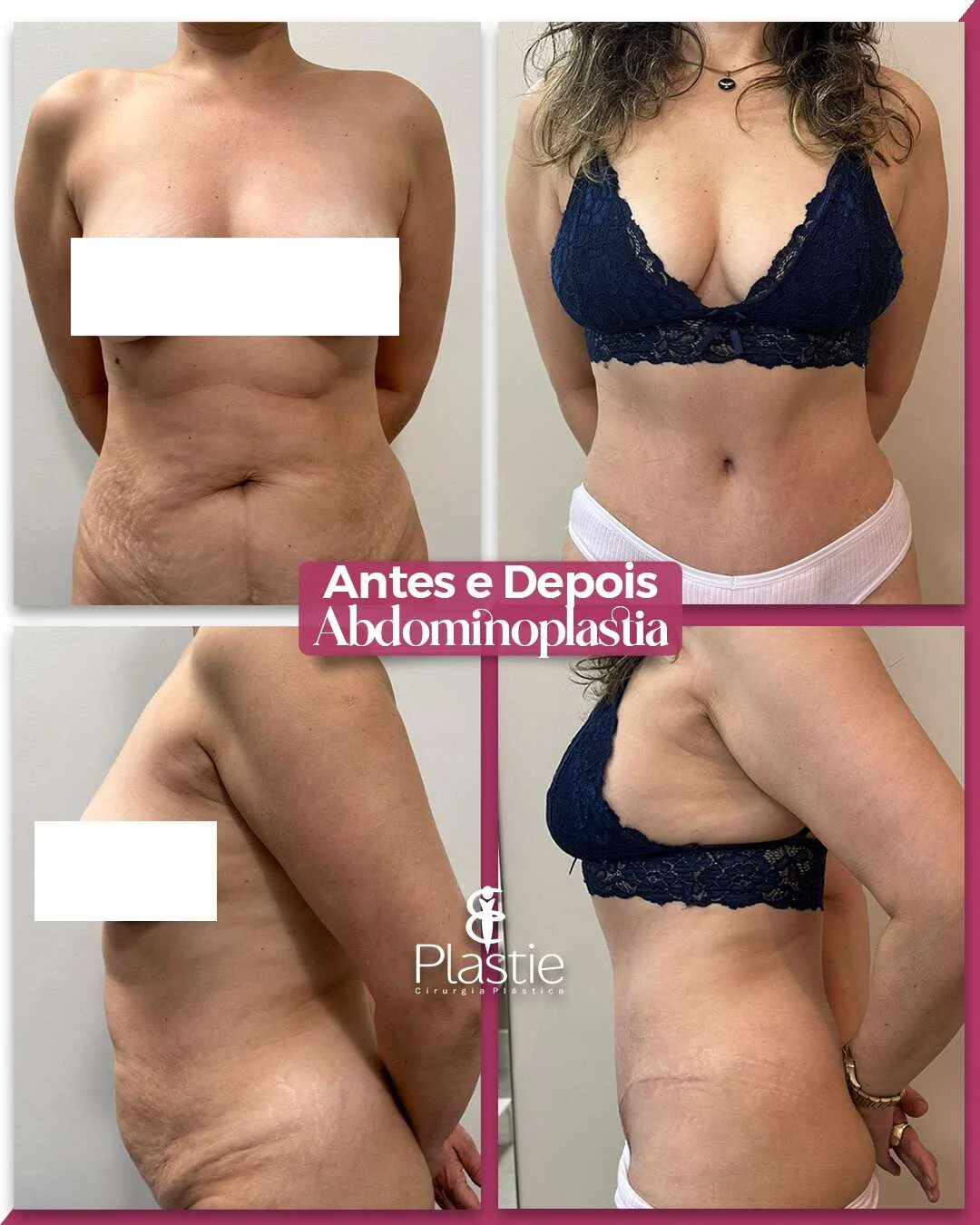 Abdominoplastia, antes e depois de paciente da Plastie