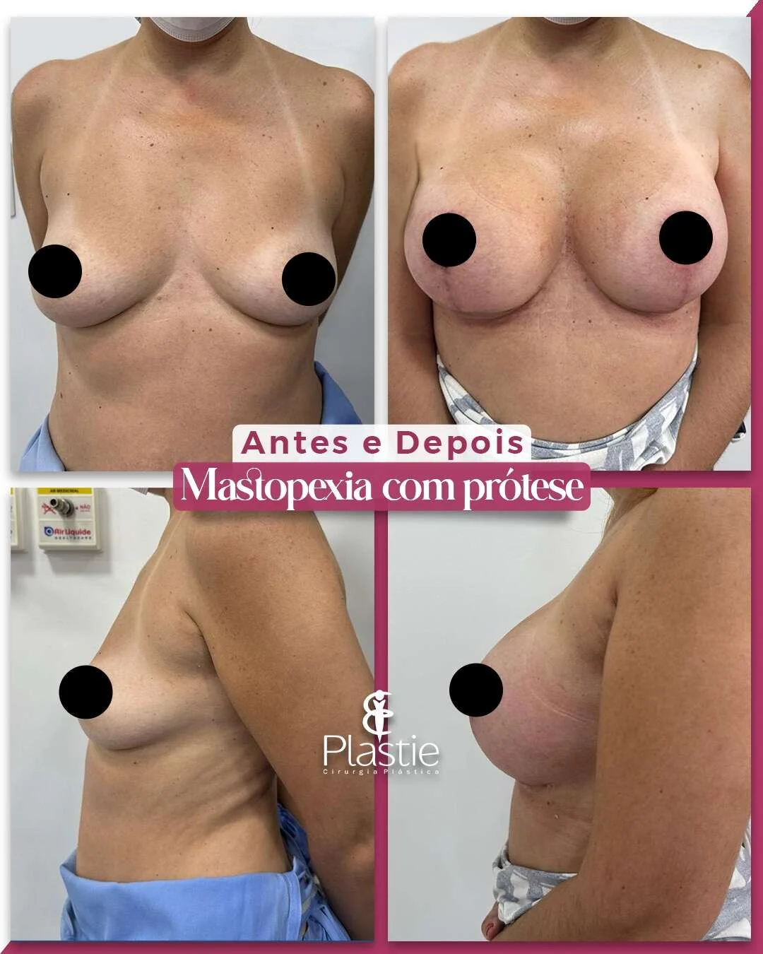 Mastopexia com prótese, antes e depois de paciente da Plastie