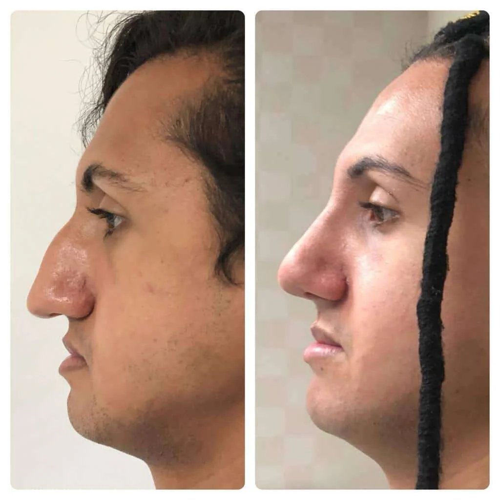 Rinoplastia, antes e depois de paciente da Plastie